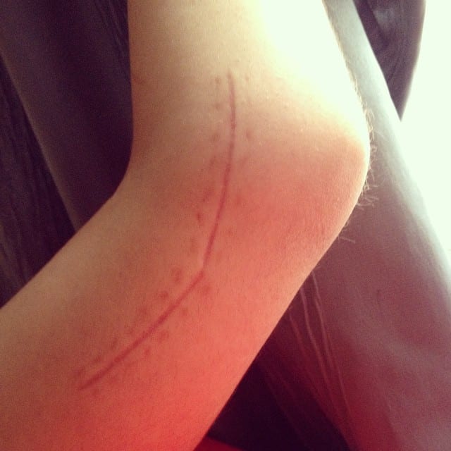 A closeup of a scar on a person\'s arm.